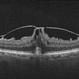 Vitreomacular Traction Syndrome Vitreomacular Traction Syndrome