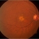 Vitelliform Macular Dystrophy Vitelliform Macular Dystrophy