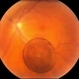 Vitreous Cyst