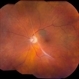 Vitromaculopathy