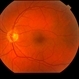 Peripapillary Glial Proliferation Peripapillary Glial Proliferation