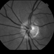 Peripapillary Glial Proliferation Peripapillary Glial Proliferation