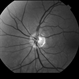 Peripapillary Glial Proliferation Peripapillary Glial Proliferation