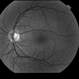 Peripapillary Glial Proliferation Peripapillary Glial Proliferation