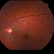 Choroidal Nevus with Drusen Choroidal Nevus with Drusen