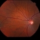 Choroidal Nevus with Drusen Choroidal Nevus with Drusen