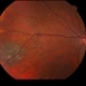 Choroidal Nevus with Drusen Choroidal Nevus with Drusen