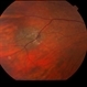 Choroidal Nevus with Drusen Choroidal Nevus with Drusen