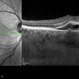 Central Serous Retinopathy with Fibrin Central Serous Retinopathy with Fibrin