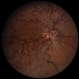 Wyburn-Mason Syndrome Wyburn-Mason Syndrome