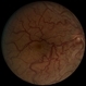Wyburn-Mason Syndrome Wyburn-Mason Syndrome