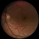 Wyburn-Mason Syndrome Wyburn-Mason Syndrome