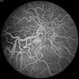 Wyburn-Mason Syndrome Wyburn-Mason Syndrome