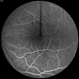 Wyburn-Mason Syndrome Wyburn-Mason Syndrome