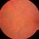 Chronic Retinal Vein Occlusion Chronic Retinal Vein Occlusion