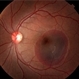 Submacular Hemorrhage Submacular Hemorrhage
