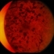 Venous Stasis Retinopathy Venous Stasis Retinopathy