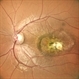 SCARRED CHOROIDAL NEOVASCULAR MEMBRANE SCARRED CHOROIDAL NEOVASCULAR MEMBRANE