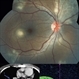 Choroidal Granuloma Choroidal Granuloma