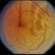Scleritis / OIS Scleritis / OIS