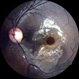 Traumatic Macular Hole Traumatic Macular Hole