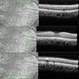 Thickened Posterior Hyaloid in Stickler Syndrome