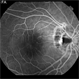 Optic Nerve Pit Related Serous Retinal Detachment