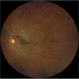Branch retinal vein occlusion - Colour & Red free image - ring shaped collaterals
