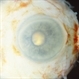 Enucleated Cataractous Lens Seen Through the Pupil Enucleated Cataractous Lens Seen Through the Pupil