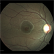 Thickness Macular Hole Thickness Macular Hole