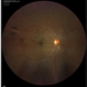 Multiple Chorodial Ruptures Multiple Chorodial Ruptures