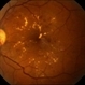 Clinically Significant Macular Edema Clinically Significant Macular Edema