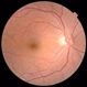 Normal Fundus image