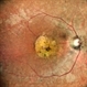 HEREDITARY MACULAR DEGENERATION HEREDITARY MACULAR DEGENERATION