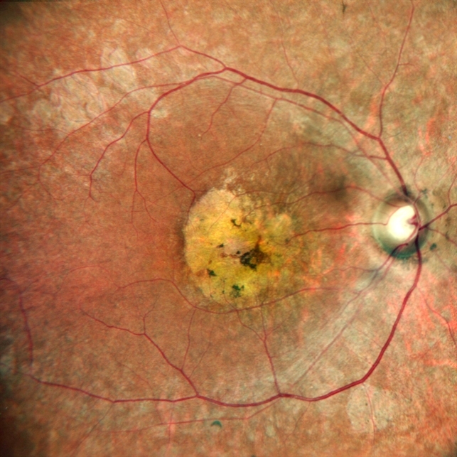 HEREDITARY MACULAR DEGENERATION Retina Image Bank