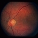 Fabry's Disease Fabry's Disease