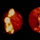 BRVO With Laser