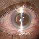 Subluxated Sulcus IOL With Small AC Bubble Subluxated Sulcus IOL With Small AC Bubble