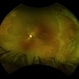 Myopia with Lattice Degeneration and White Without Pressure in the Setting of Marfan's Syndrome Myopia with Lattice Degeneration and White Without Pressure in the Setting of Marfan's Syndrome