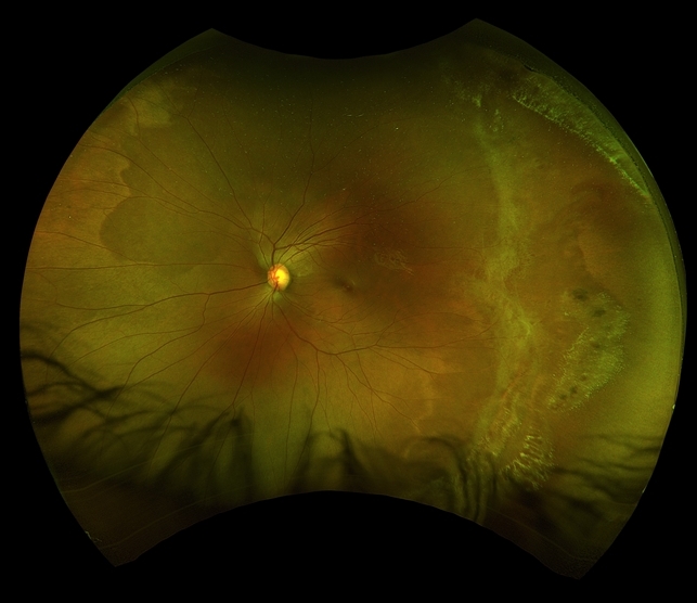 Myopia with Lattice Degeneration and White Without Pressure in the Setting of Marfan's Syndrome Myopia with Lattice Degeneration and White Without Pressure in the Setting of Marfan's Syndrome