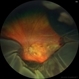 PEHCR (Peripheral Exudative Hemorrhagic Chorioretinopathy)