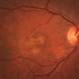 Fibrovascular Retinal Pigment Epithelial Detachment - Color Fundus