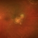 Choroidal Aspergilloma With Secondary Choroidal Neovascularization and Exudative Retinal Detachment Choroidal Aspergilloma With Secondary Choroidal Neovascularization and Exudative Retinal Detachment