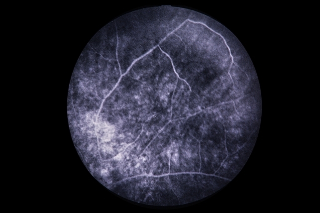 Snowflake Disorder Snowflake Vitreoretinal Degeneration – LOAG