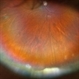 Snowbank in Intermediate Uveitis Snowbank in Intermediate Uveitis