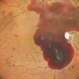 SUB-HYALOID HEMORRHAGE