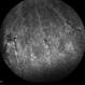 Possible Uveitis or RP Variant Possible Uveitis or RP Variant