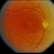 Macular Hole Evolving / Lamellar Hole Macular Hole Evolving / Lamellar Hole