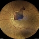 Subhyaloid Hemorrhage From a Macroaneurysm