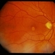 Adult Foveomacular Dystrophy / Pattern Adult Foveomacular Dystrophy / Pattern